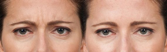 Botox & Fillers before and after pictures in East Lansing, MI, Patient 309