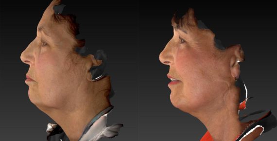 Neck Lift before and after pictures in East Lansing, MI, Patient 546