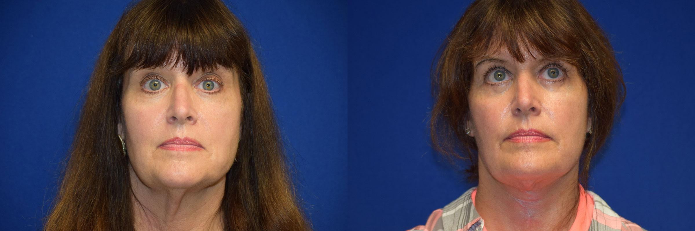 Neck Lift Before & After Photos | Ahmed Sufyan, MD