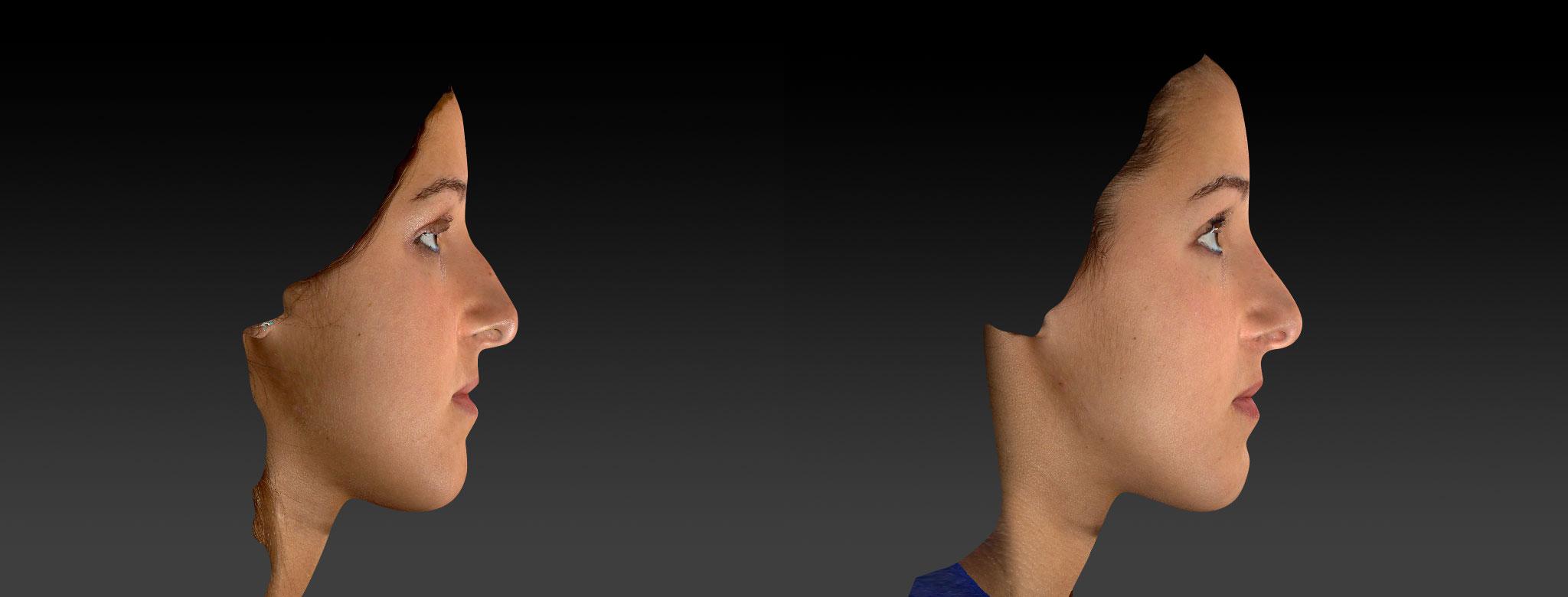 Rhinoplasty Before & After Photos | Ahmed Sufyan, MD