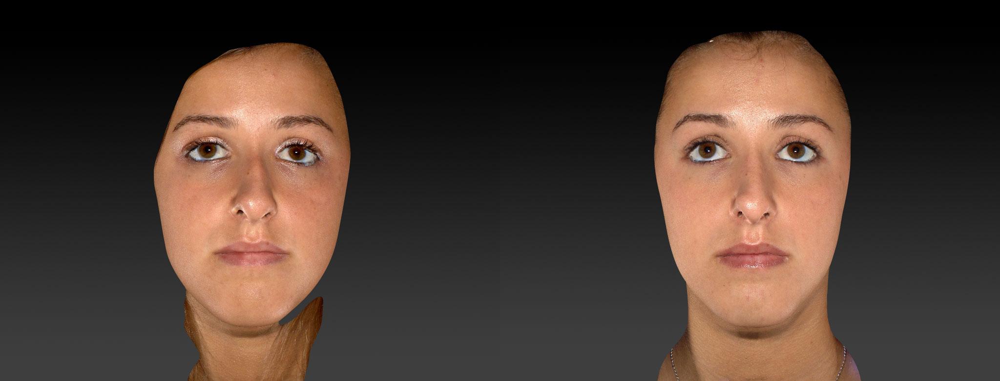 Rhinoplasty Before & After Photos | Ahmed Sufyan, MD