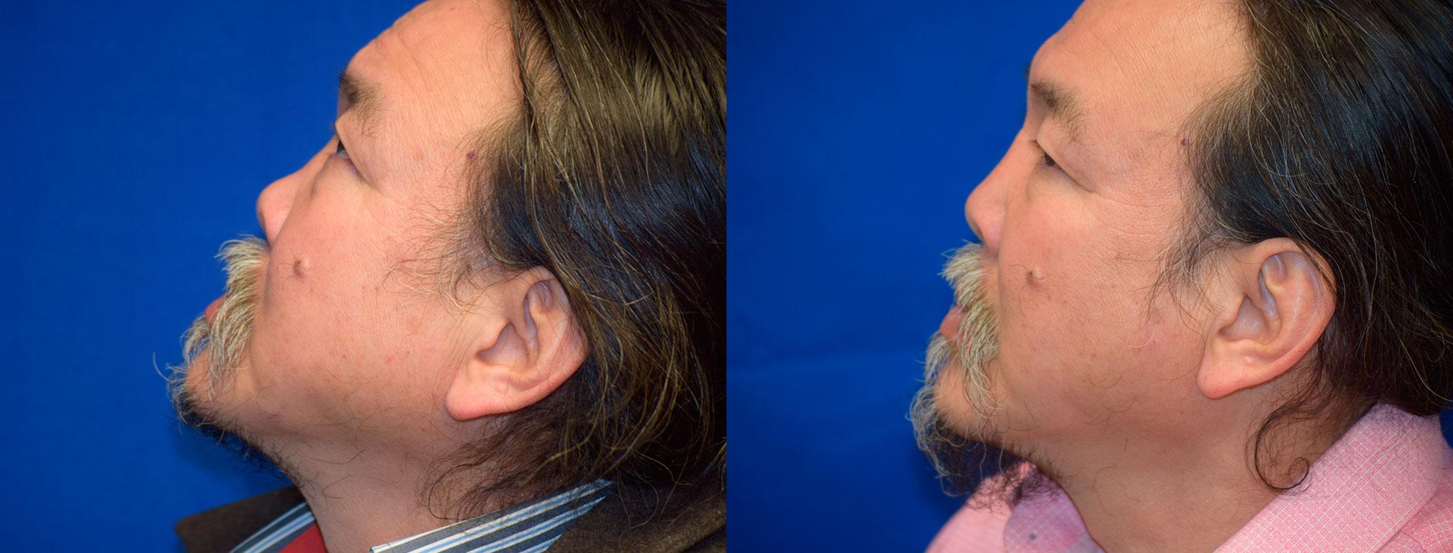 Rhinoplasty Before & After Photos | Ahmed Sufyan, MD