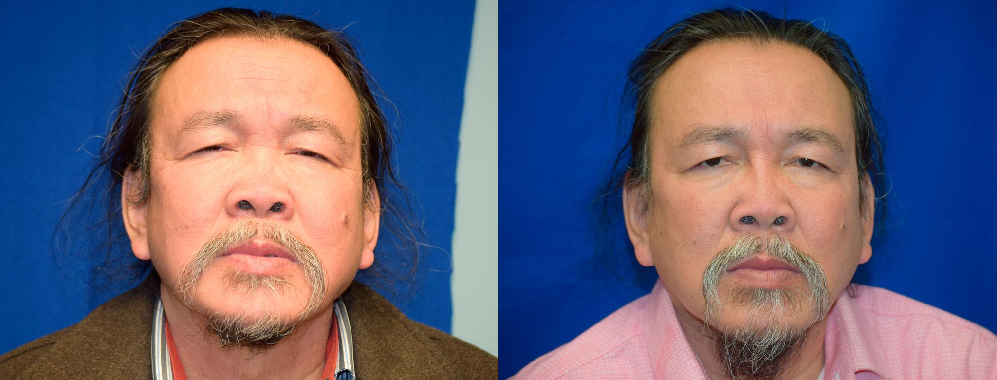 Rhinoplasty Before & After Photos | Ahmed Sufyan, MD