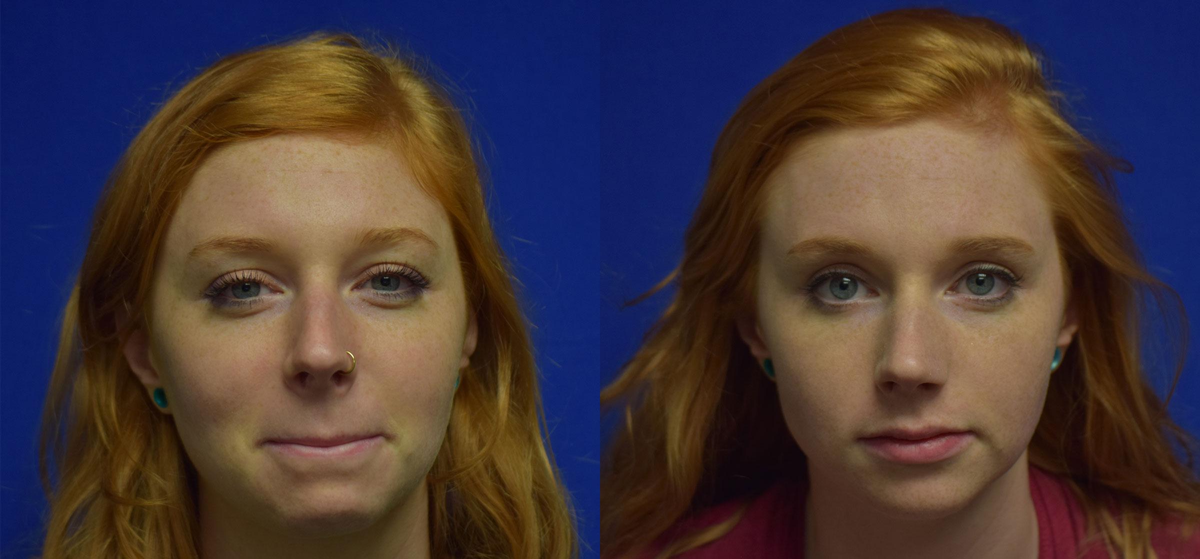 Rhinoplasty Before & After Photos | Ahmed Sufyan, MD