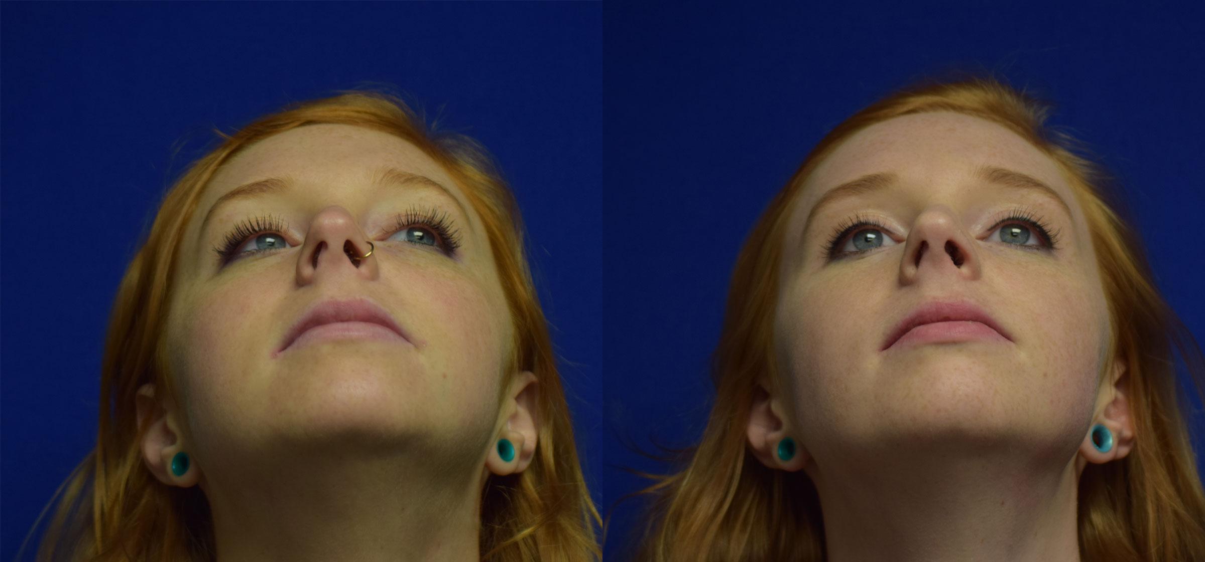 Rhinoplasty Before & After Photos | Ahmed Sufyan, MD