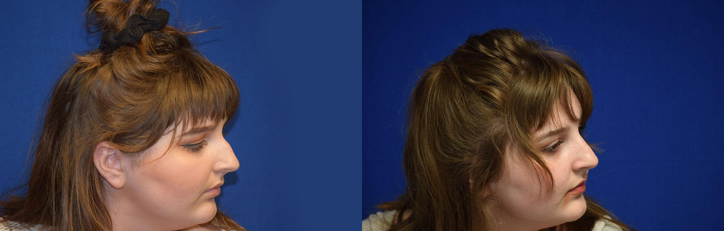 Rhinoplasty Before & After Photos | Ahmed Sufyan, MD