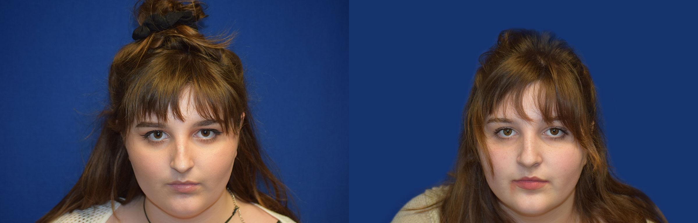 Rhinoplasty Before & After Photos | Ahmed Sufyan, MD