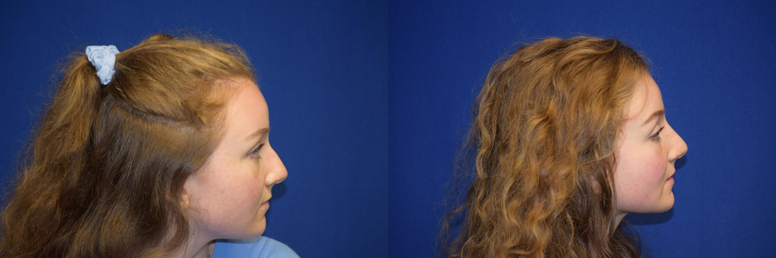 Rhinoplasty Before & After Photos | Ahmed Sufyan, MD