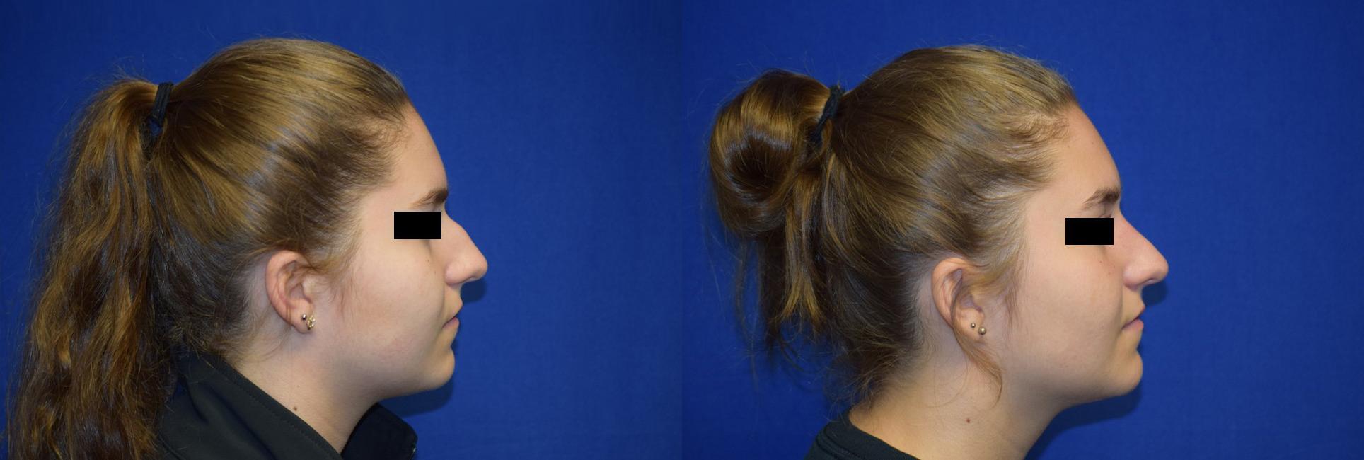 Rhinoplasty Before & After Photos | Ahmed Sufyan, MD