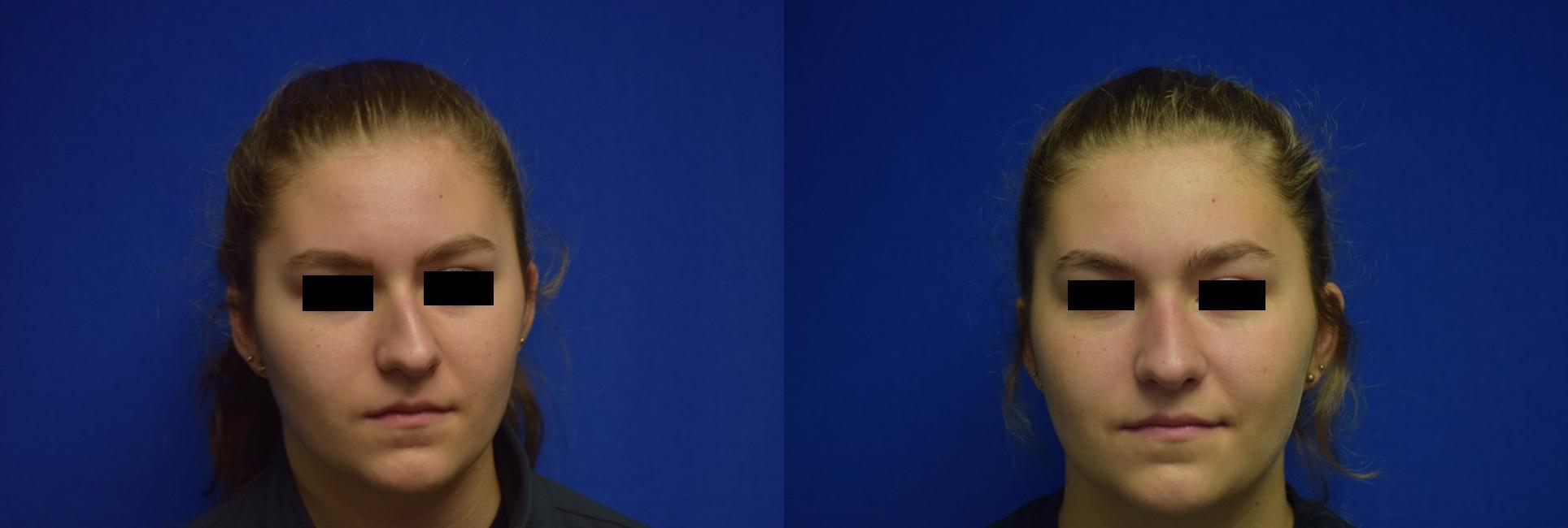 Rhinoplasty Before & After Photos | Ahmed Sufyan, MD