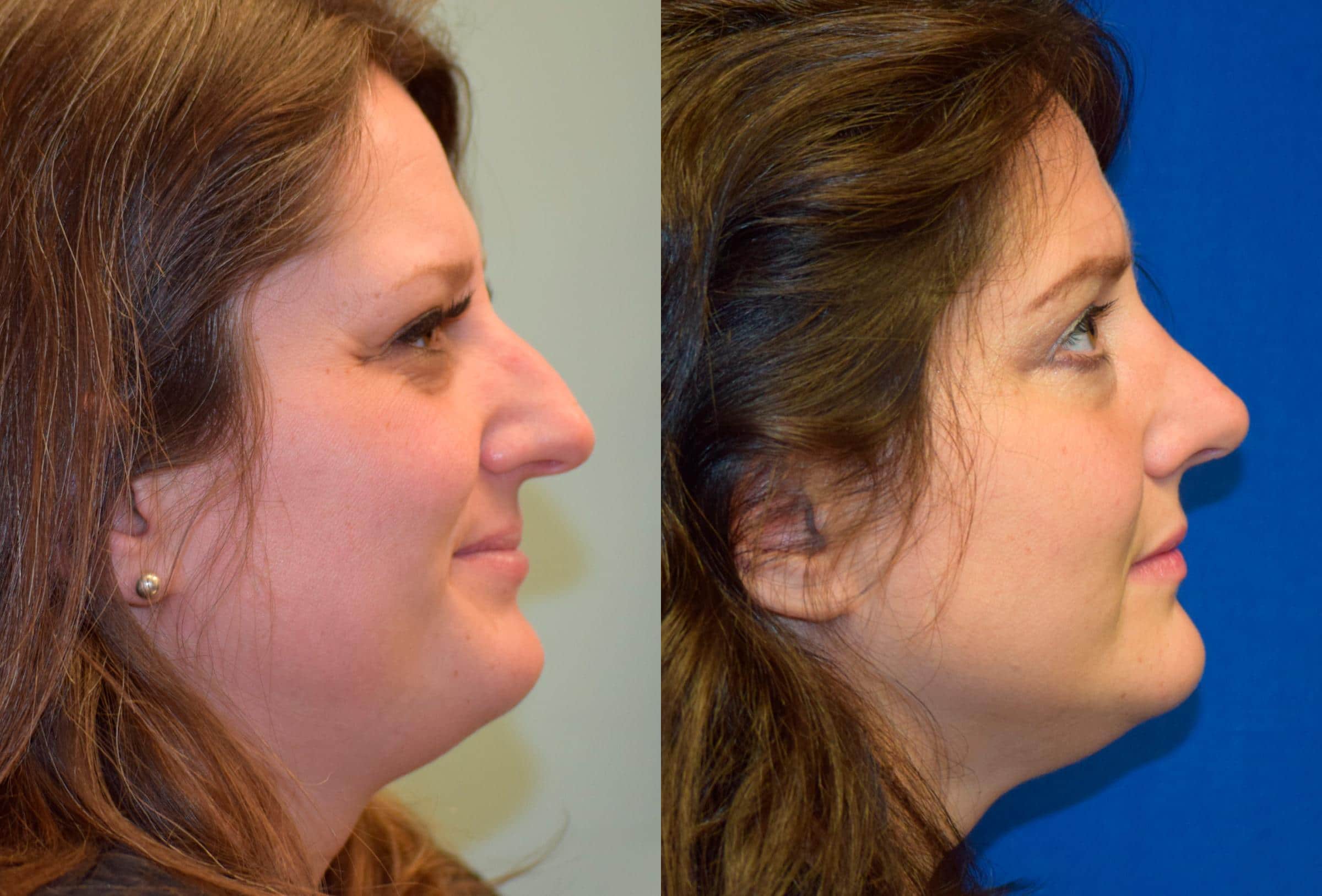 Rhinoplasty Before & After Photos | Ahmed Sufyan, MD