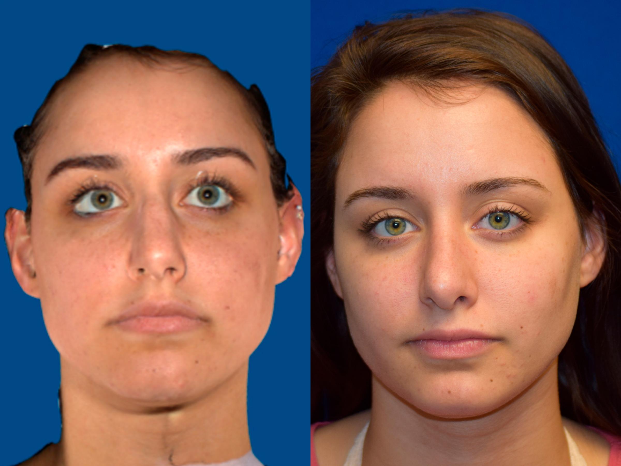 Rhinoplasty Before & After Photos | Ahmed Sufyan, MD