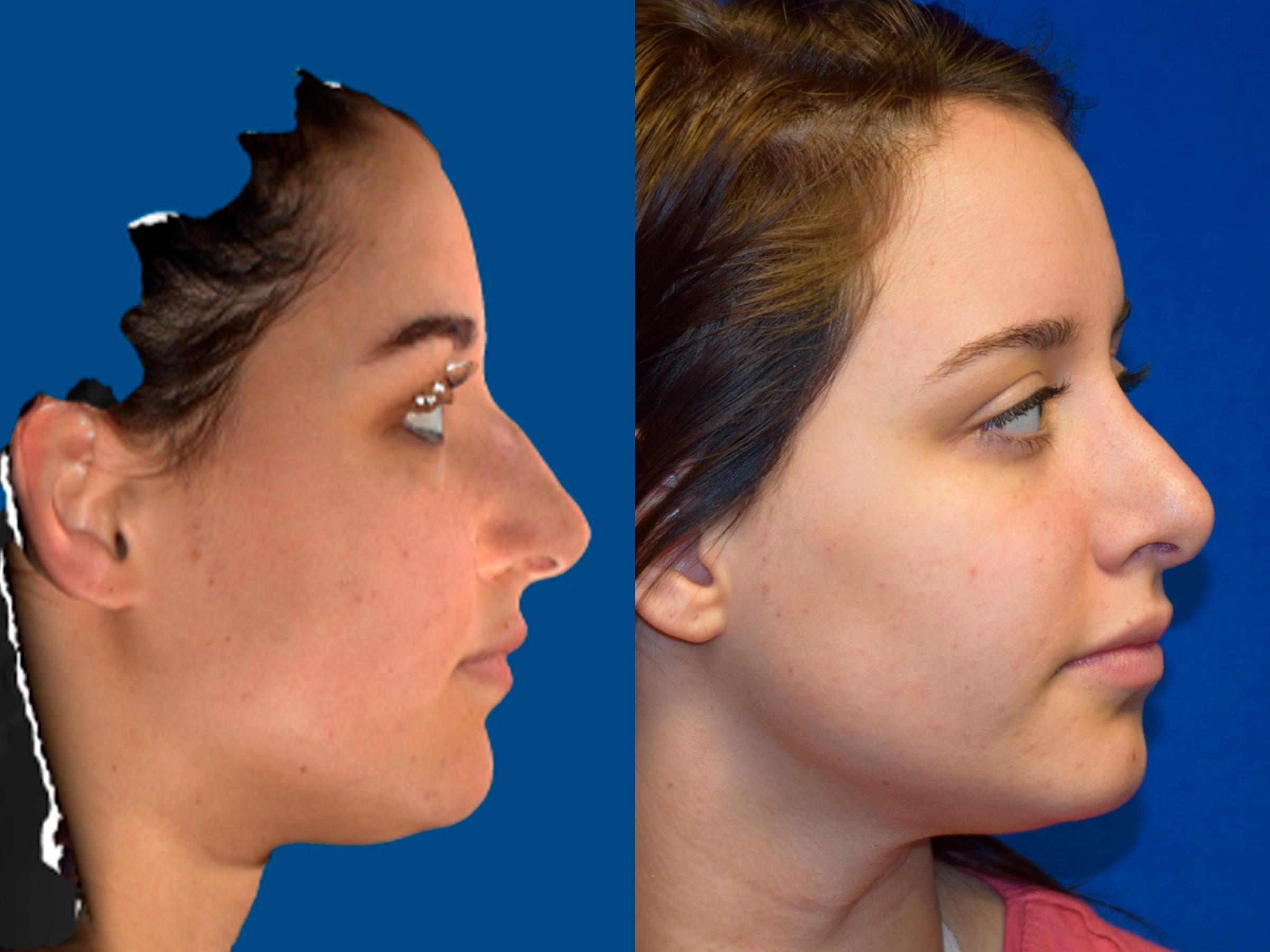 Rhinoplasty Before & After Photos | Ahmed Sufyan, MD