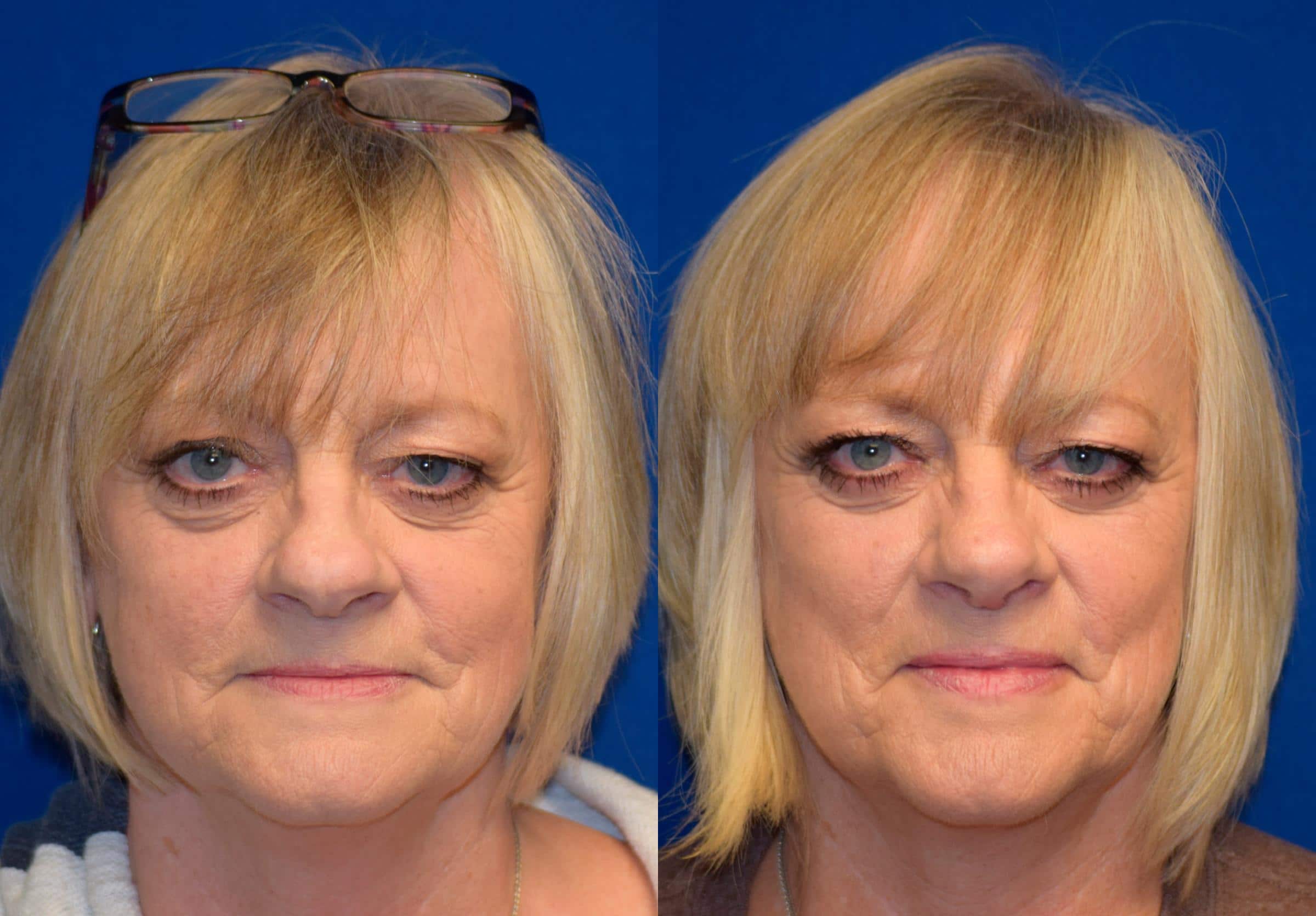 Rhinoplasty Before & After Photos | Ahmed Sufyan, MD