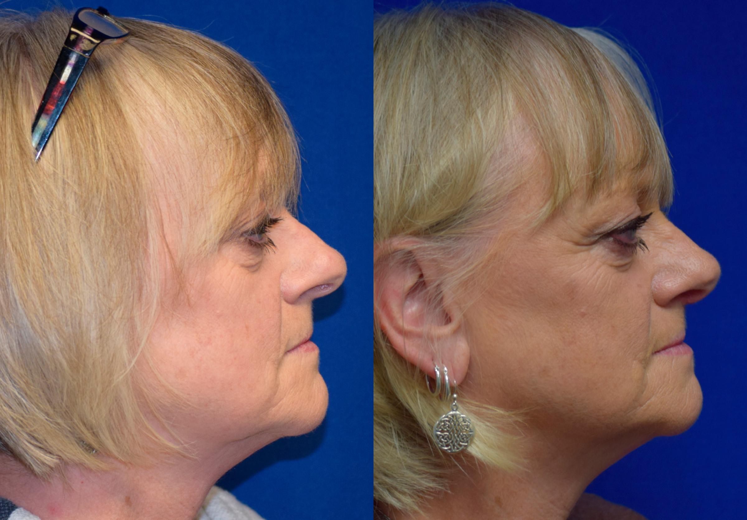 Rhinoplasty Before & After Photos | Ahmed Sufyan, MD