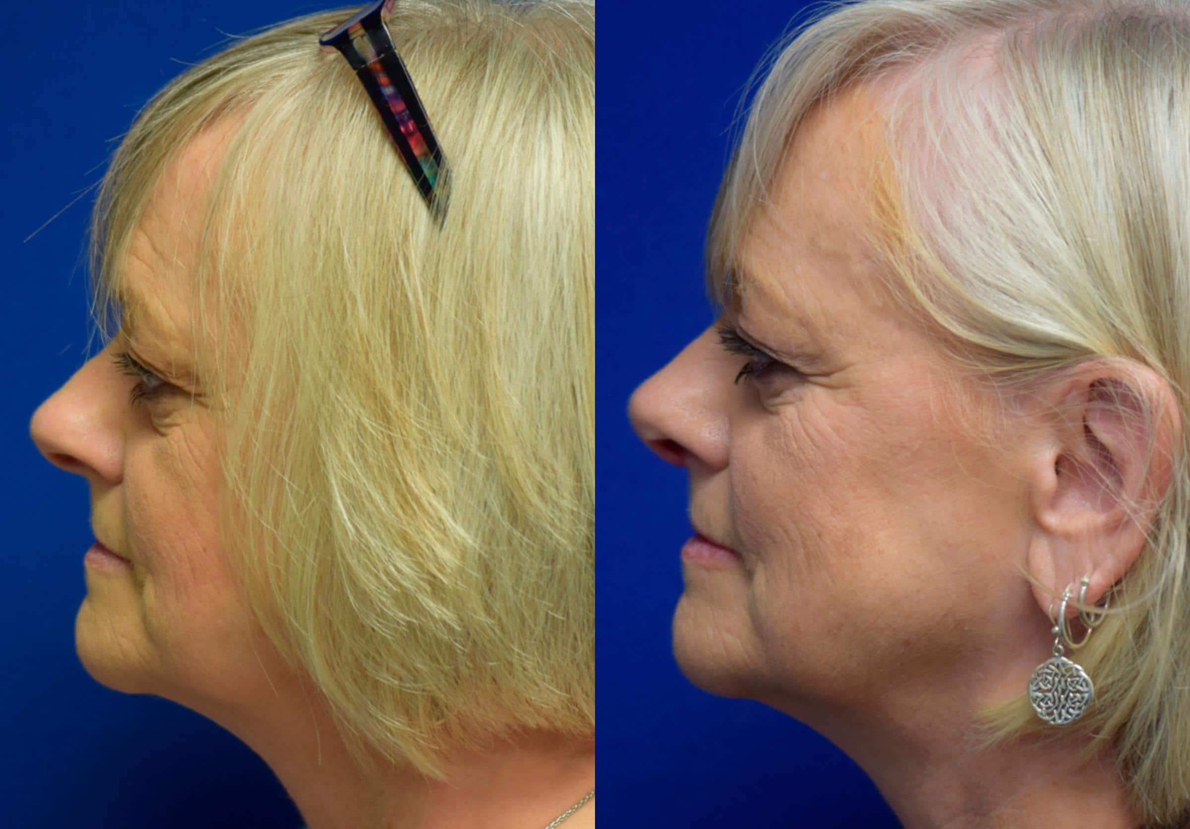 Rhinoplasty Before & After Photos | Ahmed Sufyan, MD