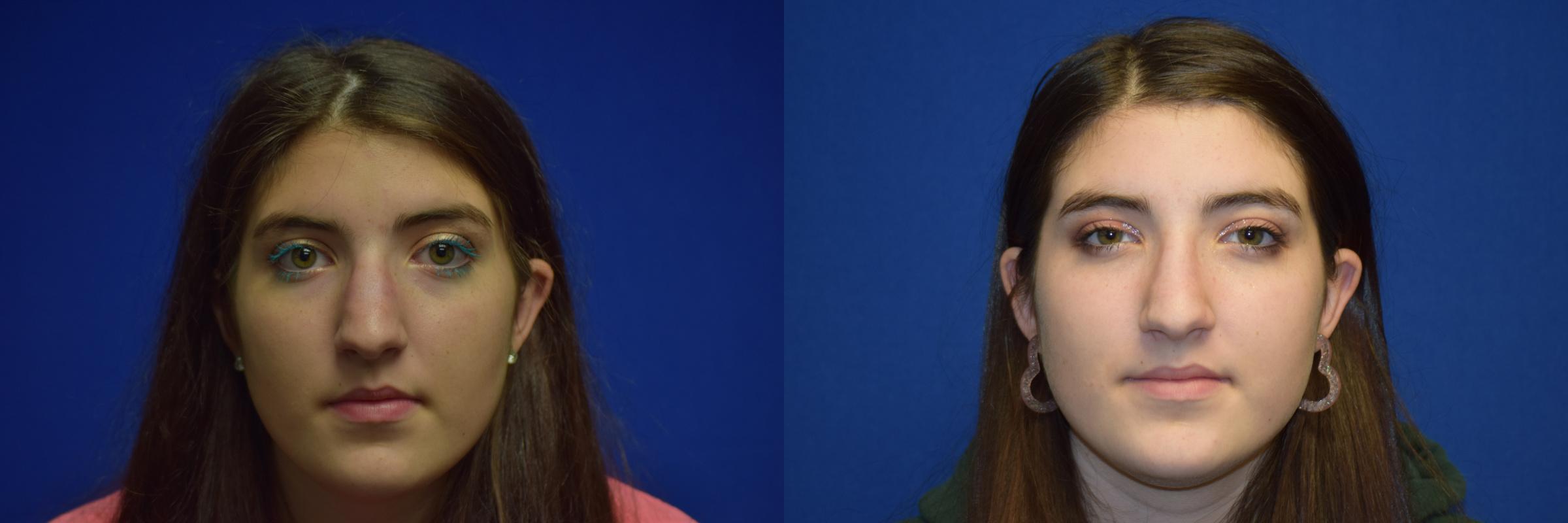 Rhinoplasty Before & After Photos | Ahmed Sufyan, MD