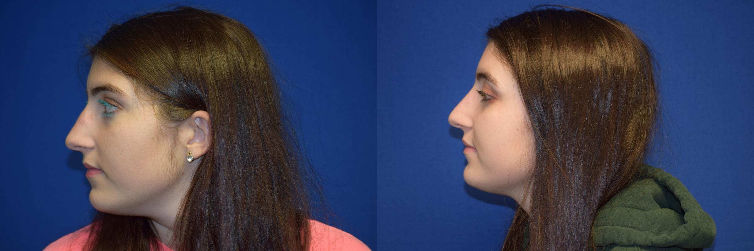 Rhinoplasty Before & After Photos | Ahmed Sufyan, MD