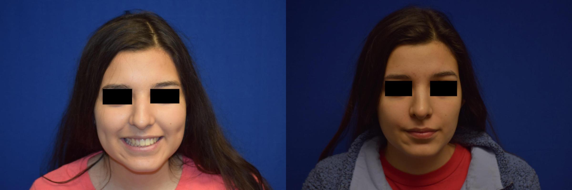 Rhinoplasty Before & After Photos | Ahmed Sufyan, MD