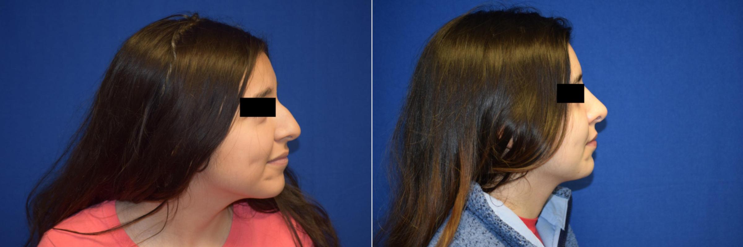 Rhinoplasty Before & After Photos | Ahmed Sufyan, MD