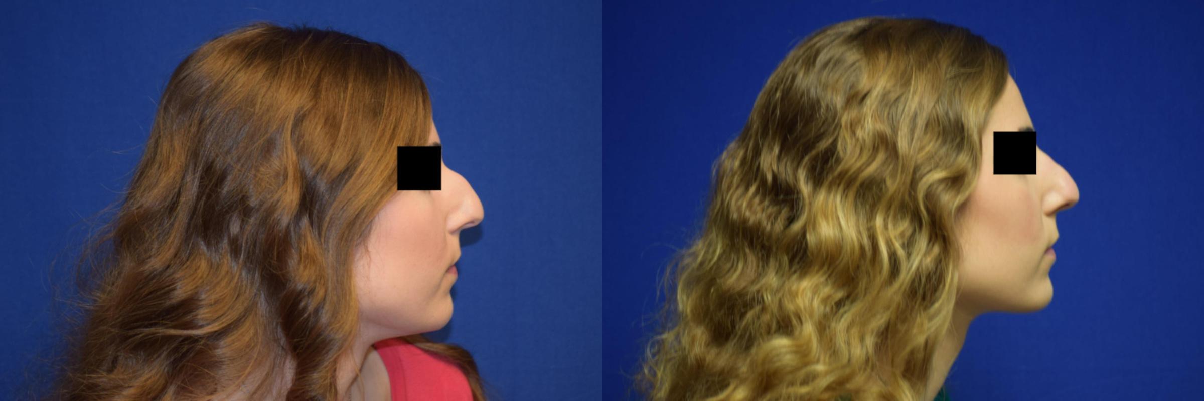 Rhinoplasty Before & After Photos | Ahmed Sufyan, MD