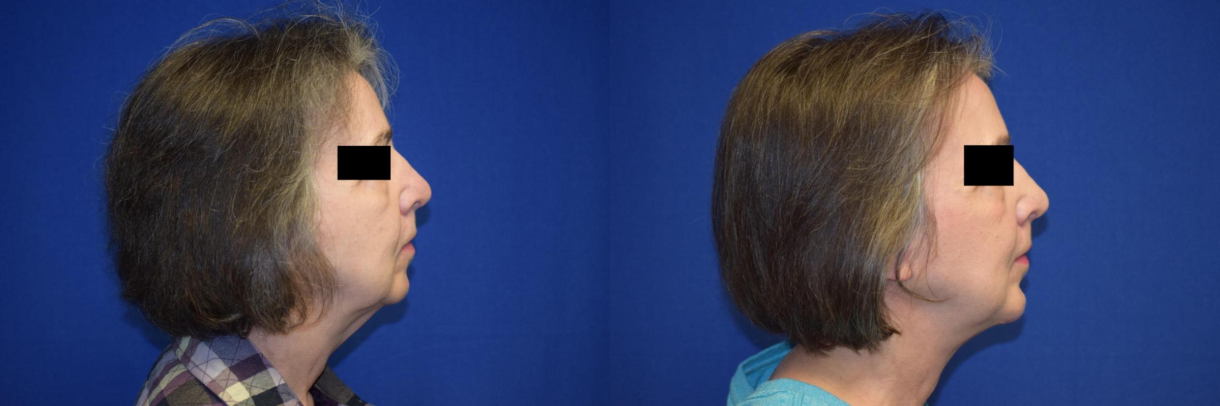 Neck Lift Before & After Photos | Ahmed Sufyan, MD